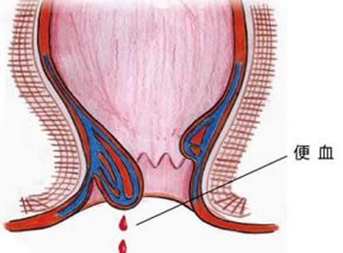 产后便血怎么回事 产妇产后便血