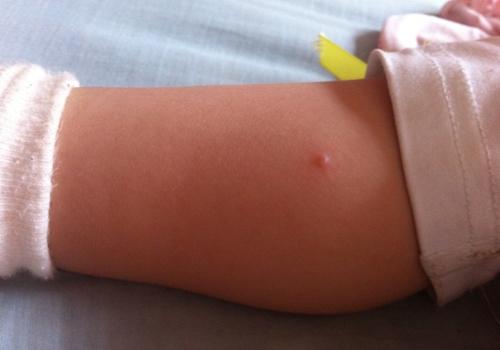 水痘先从哪里起来 水痘先从哪里长起来