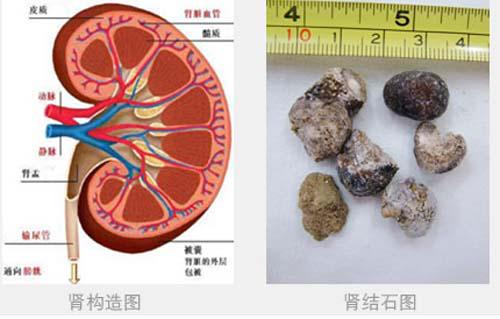 肾结石需要做手术吗 8mm的肾结石需要做手术吗