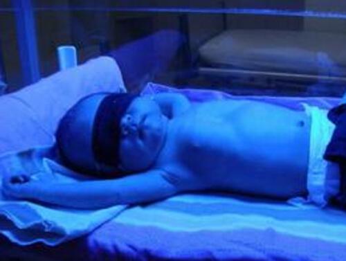 新生儿黄疸照蓝光有副作用吗（新生儿黄疸照蓝光有什么副作用吗）