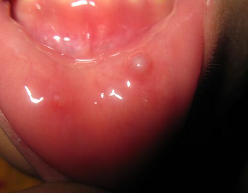 老人口腔溃疡是什么原因 老人长期口腔溃疡是什么原因造成的