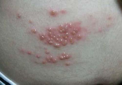 得了湿疹能晒太阳吗 湿疹还能晒太阳吗