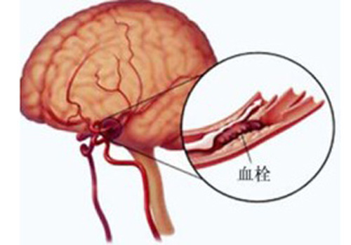 脑血栓能治好吗 老年人得脑血栓能治好吗