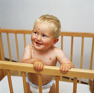 水痘的症状和预防 水痘的症状和预防措施