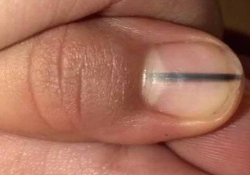 指甲上有黑线是癌症吗(指甲黑线癌症前兆有哪些)