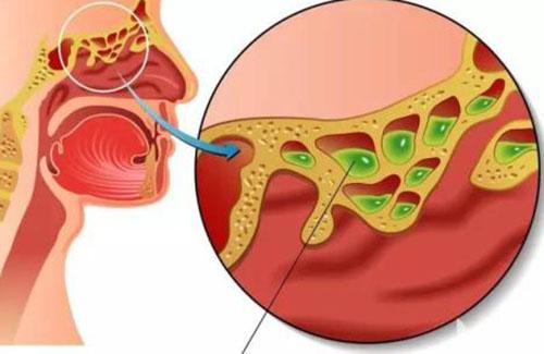 鼻窦炎有哪些症状 鼻窦炎有哪些症状怎么治疗