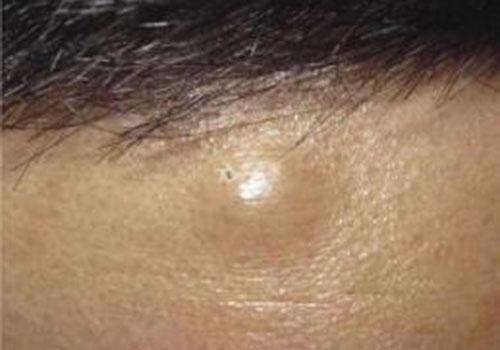 脂肪瘤会癌变吗（脂肪瘤会癌变吗 后背鸡蛋大小）