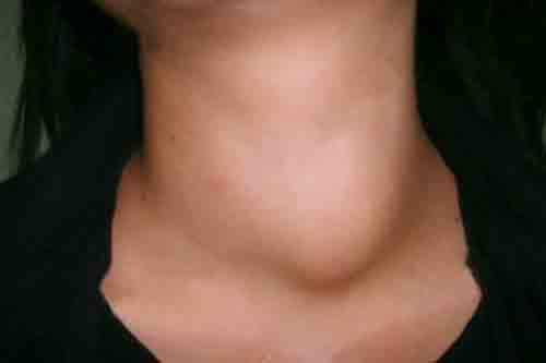 甲亢和甲状腺一样吗（甲状腺是甲亢吗）