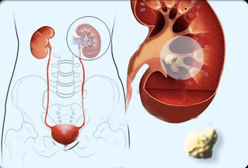 肾结石饮食注意事项 肾结石注意事项及饮食禁忌