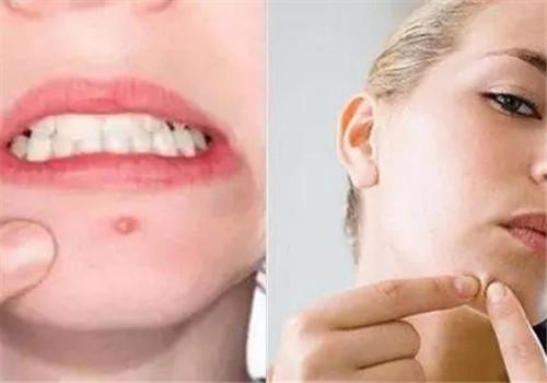 下巴为何经常长痘(为何下巴总是长痘)