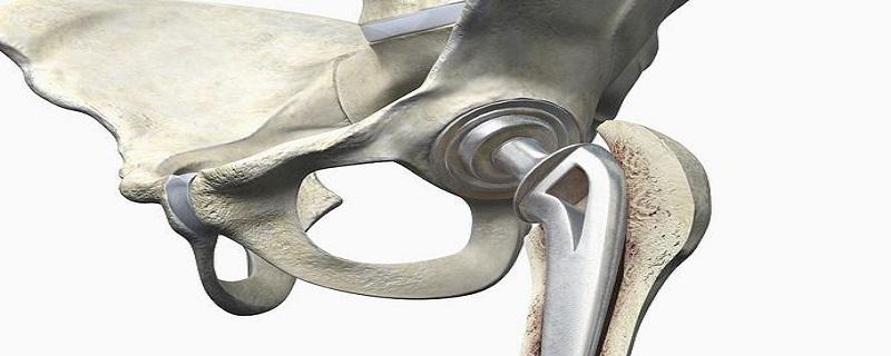 髋关节置换假体有哪些材料（髋关节置换的假体材料）