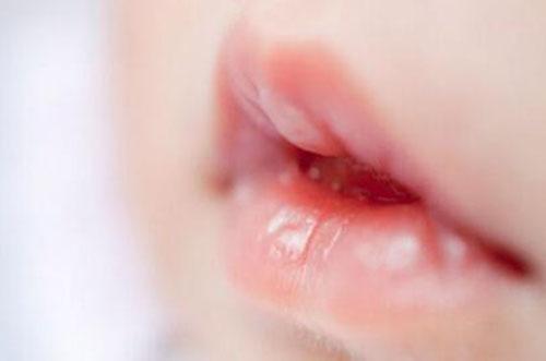 宝宝嘴唇干裂怎么办 一岁半宝宝嘴唇干裂怎么办