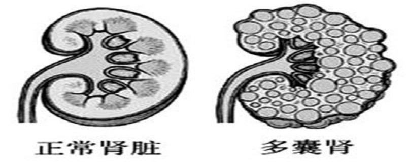 多囊肾怎么检测出来（多囊肾病怎么检查）