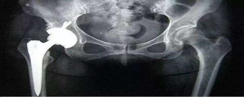 髋关节置换材料选择 髋关节置换可以用多久