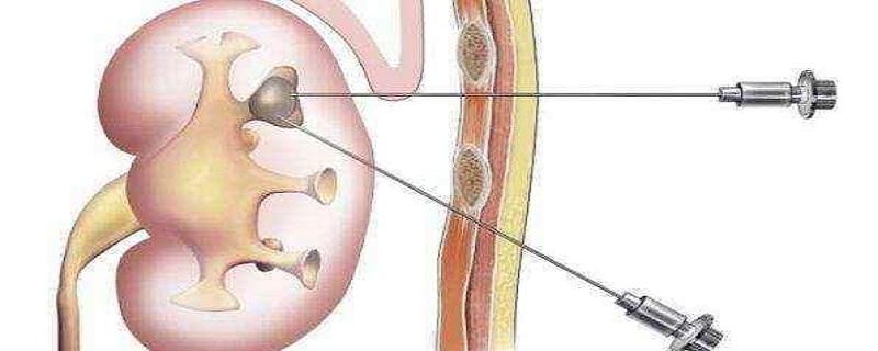 做肾穿刺有危险吗 肾穿刺对身体有危害吗