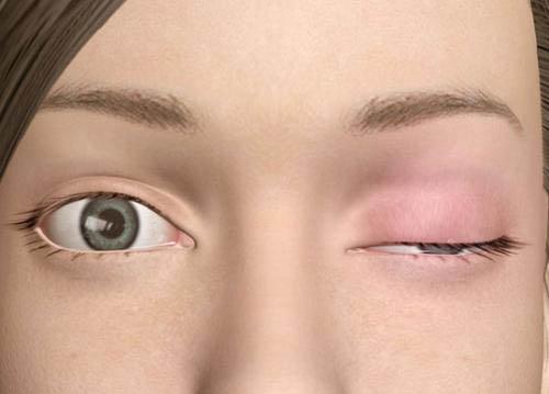 重症肌无力护理措施 重症肌无力护理措施的重点是