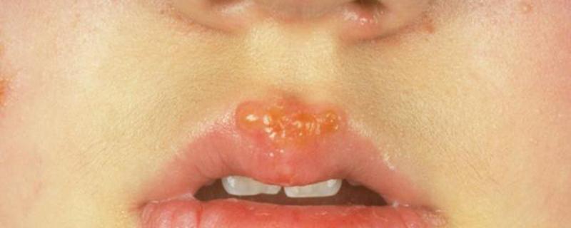 嘴上起泡怎样快速下去(吃热了嘴上起泡怎样快速下去)