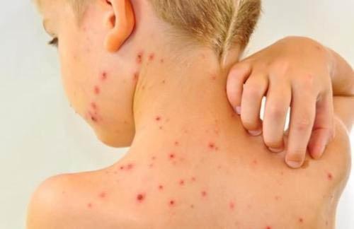 宝宝水痘症状 宝宝水痘症状初期图片