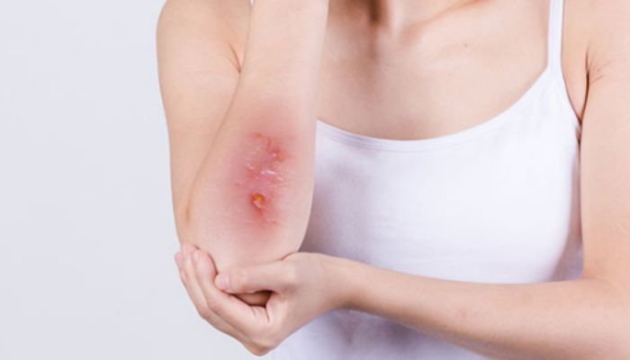 芦荟胶可以涂伤口吗 芦荟胶能不能涂伤口