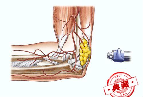 网球肘最佳治疗方法