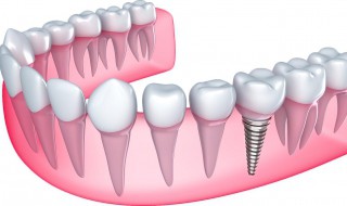 如何清洗假牙 怎样清洗假牙