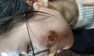 水痘坑的修复方法 水痘坑的修复方法介绍