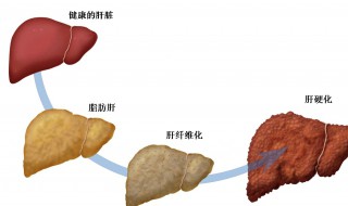 脂肪肝是啥意思 脂肪肝介绍