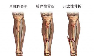 骨折病人不能吃什么 有哪些禁忌？