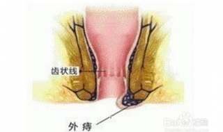 痔疮治疗方法 四种科学治疗方法