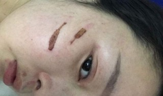 去疤去印的方法 去疤去印的方法是什么