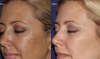 怎么去除黄褐斑 去除黄褐斑的方法