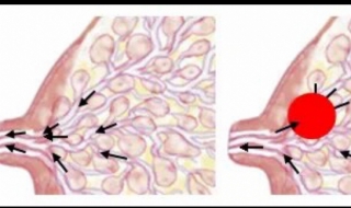 乳汁淤积怎么办 有什么方法解决？