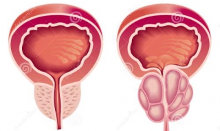 前列腺肥大怎么办 三种治疗手段分享