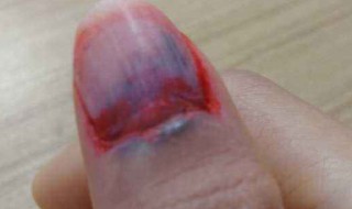 手指冷敷如何做 做冷敷的方法