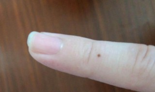 苍蝇屎在脸上怎么去掉 脸上有苍蝇屎怎么去除