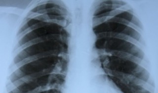 肺部小结节是什么意思 肺部小结节指的是什么