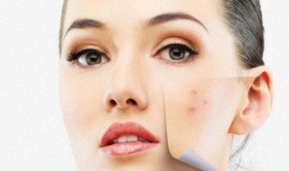 除脸上螨虫的方法 除脸上螨虫正确方法
