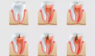 补牙用什么材料结实 一看你就知道真相