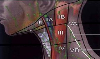 淋巴结钙化严重吗?会恶性病变吗?