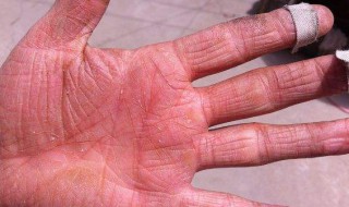 手裂口子怎么治 手老裂口子是怎么回事