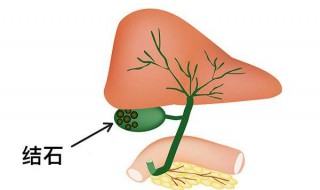 胆结石手术前可以吸烟吗 胆结石注意事项