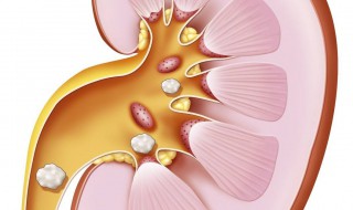 肾结石有0.7能排出吗 多大的肾结石不影响排出