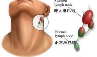 淋巴结炎会蔓延吗 如何控制淋巴结炎