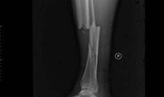 十级骨折工伤理赔项目有哪些 日常法律知识!