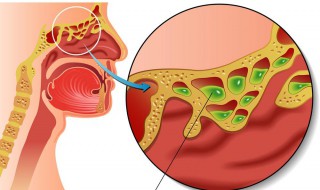 急性鼻窦炎怎样治疗 主要有这些治疗手段