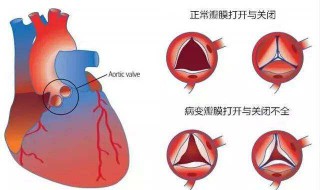 国产瓣膜和进口瓣膜区别 国产和进口瓣膜的差别