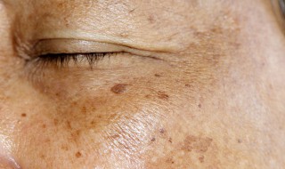 祛黄褐斑最好的方法 祛黄褐斑怎么去除