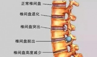 腰椎反弓怎么恢复 学会这几点