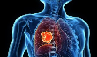 肺泡是怎么回事 肺部炎症怎么治疗？