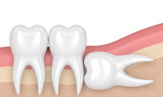 为什么不建议拔智齿 拔智齿有什么坏处